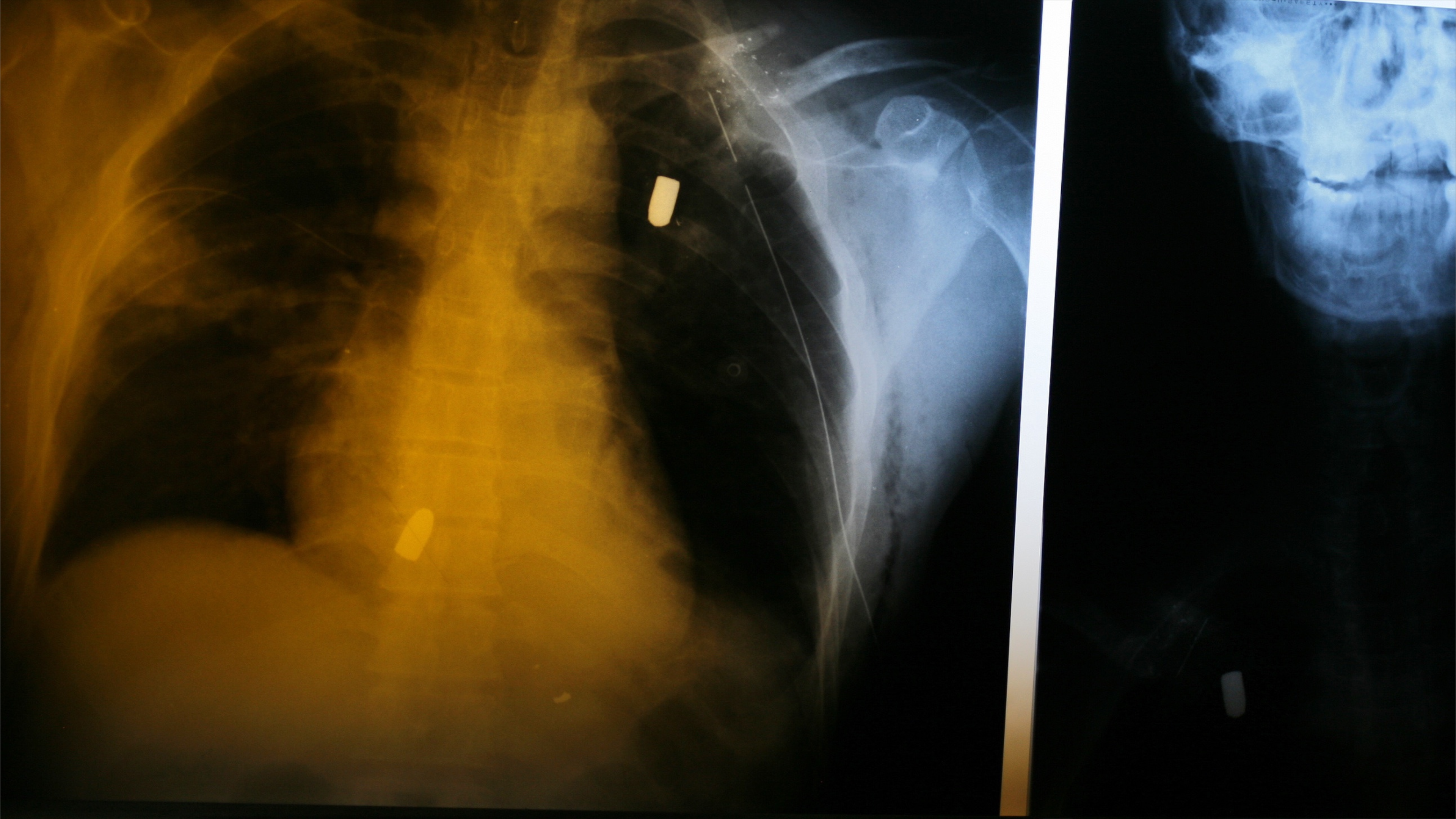 الأشعة تكشف ما خلف الرصاص.. إصابات مدمّرة في احتجاجات إيران