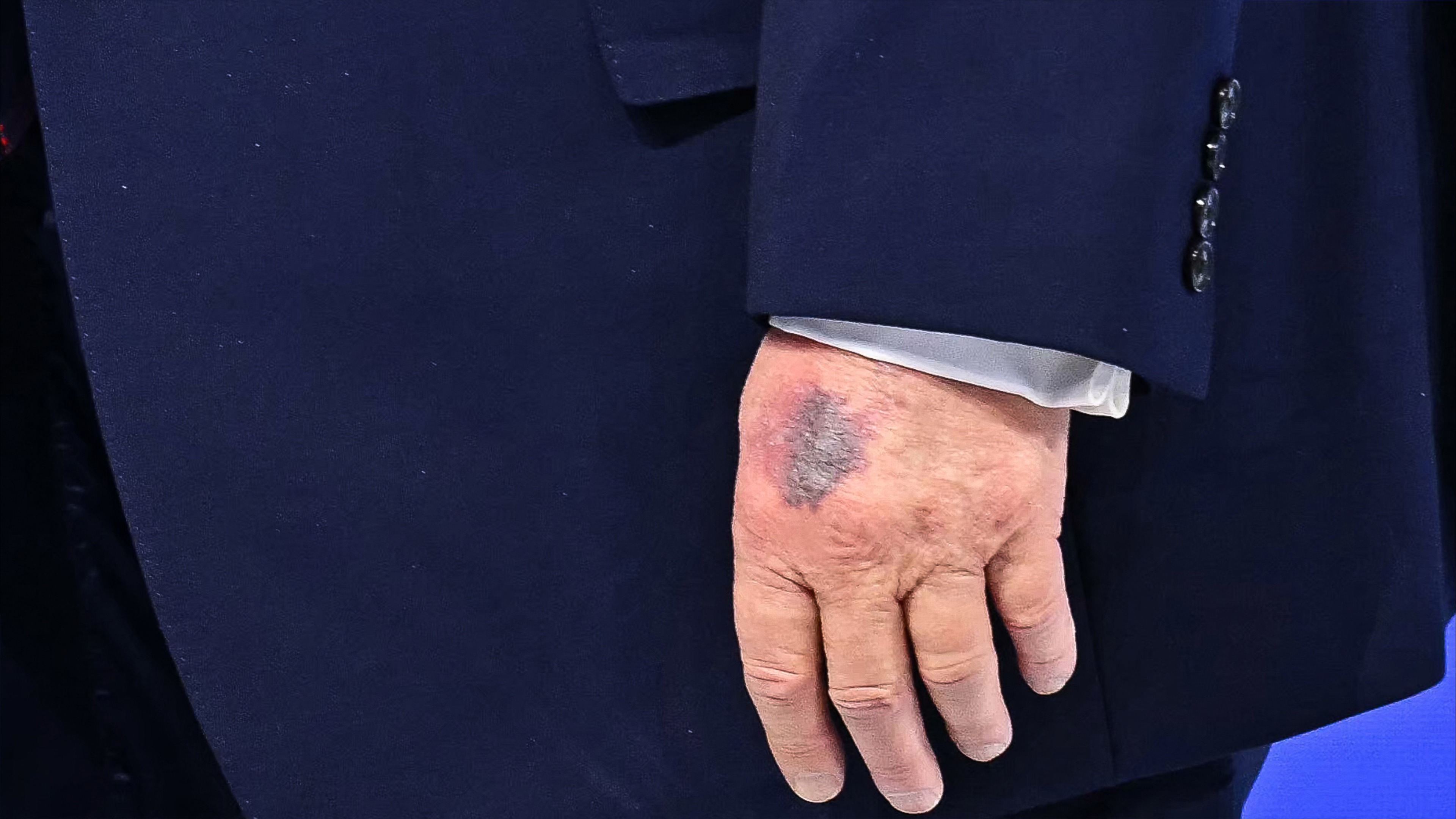 ترامب عن كدمة يده.. أسبرين وطاولة دافوس