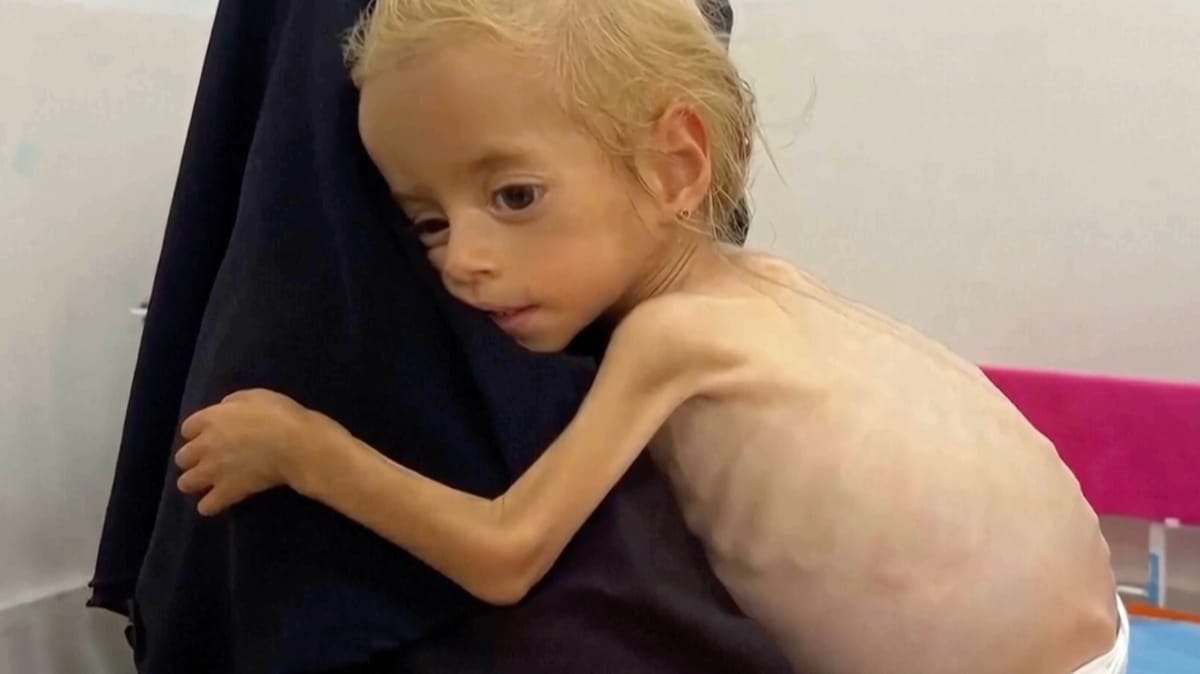 كيف تجاوزت "شام" مجاعة غزة واستعادت جزءا من وزنها؟