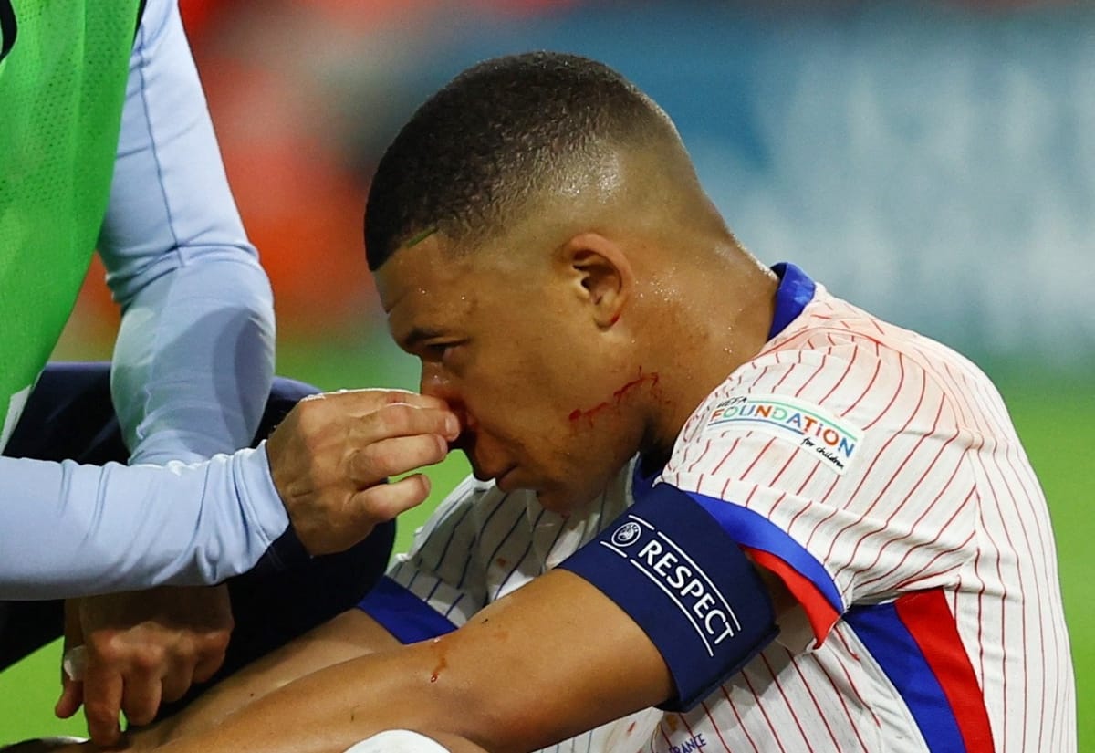غياب محتمل.. أنف مبابي يورط فرنسا في يورو 2024