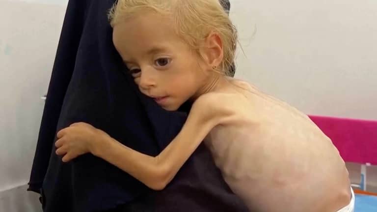 كيف تجاوزت "شام" مجاعة غزة واستعادت جزءا من وزنها؟
