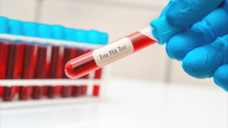 "إهمال بسيط" يزيد وفيات سرطان البروستاتا