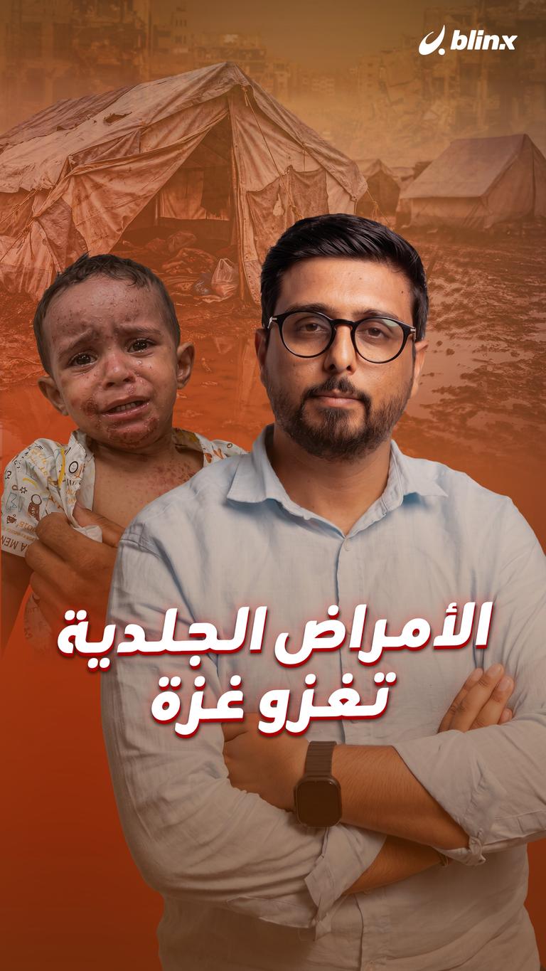 الأمراض الجلدية    تغزو غزة