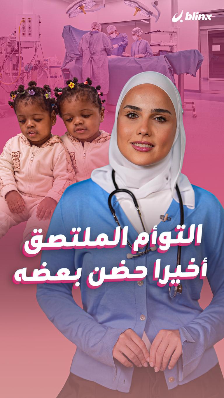 التوأم الملتصق... أخيرا حضن بعضه