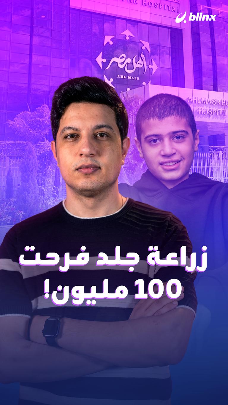 زراعة جلد فرحت 100 مليون!